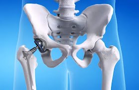 HIP REPLACEMENT SURGERY