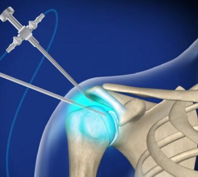 Shoulder Arthroscopy