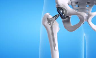 Robotic Hip Replacement: Is It Right for You?